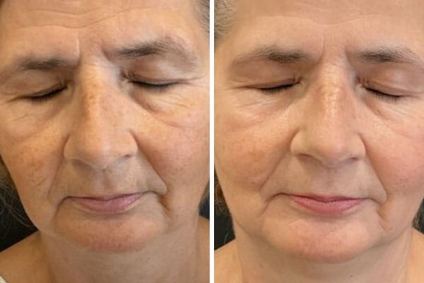 Before and after results of microneedling in Fort Wayne.