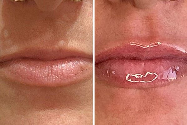 Real patient before and after results of microneedling in Fort Wayne.